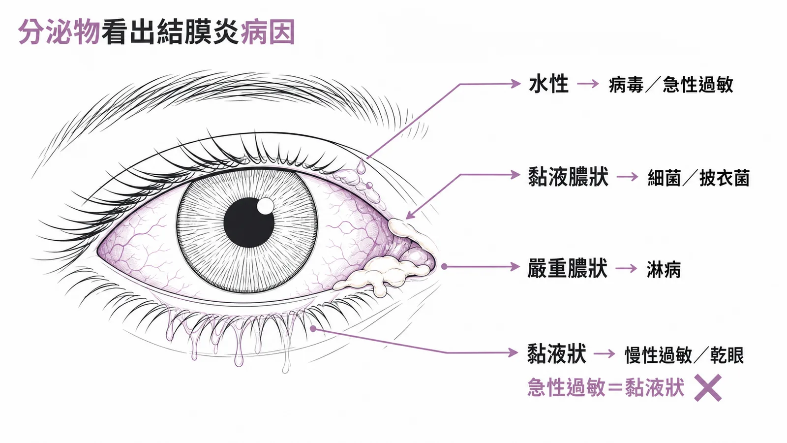 結膜炎分泌物型態與病因對照示意圖