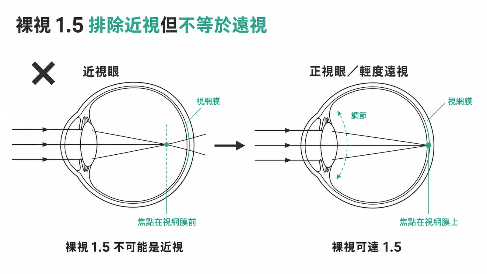 裸視 1.5 排除近視但不等於遠視的屈光原理示意圖
