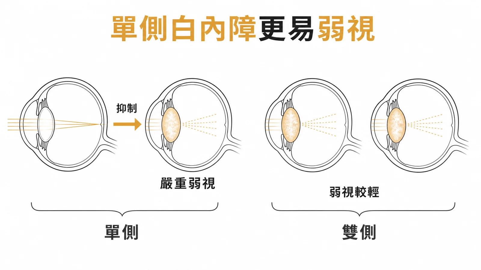 單側白內障健眼抑制患眼更易弱視示意圖