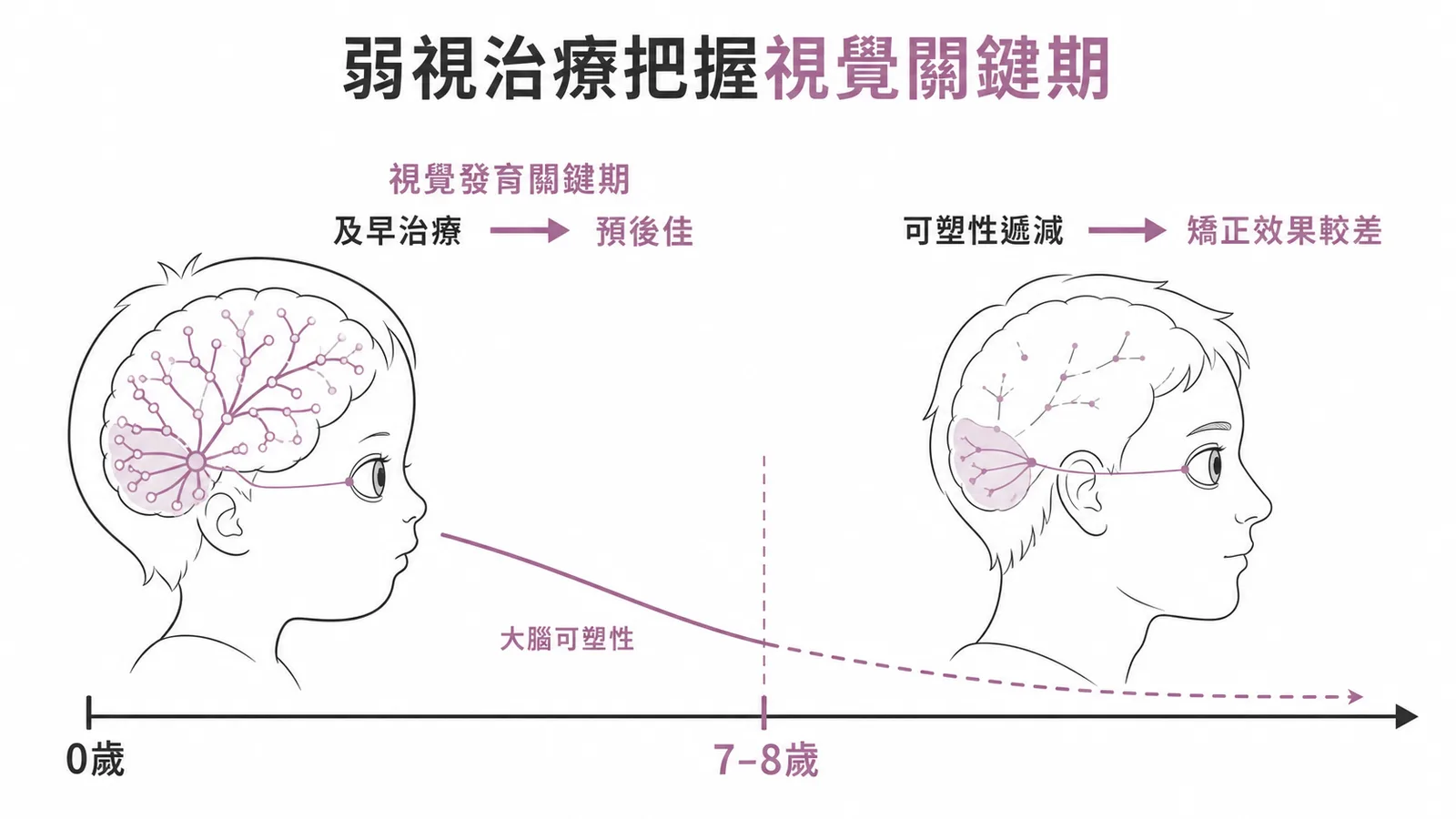 弱視治療須把握視覺發育關鍵期示意圖