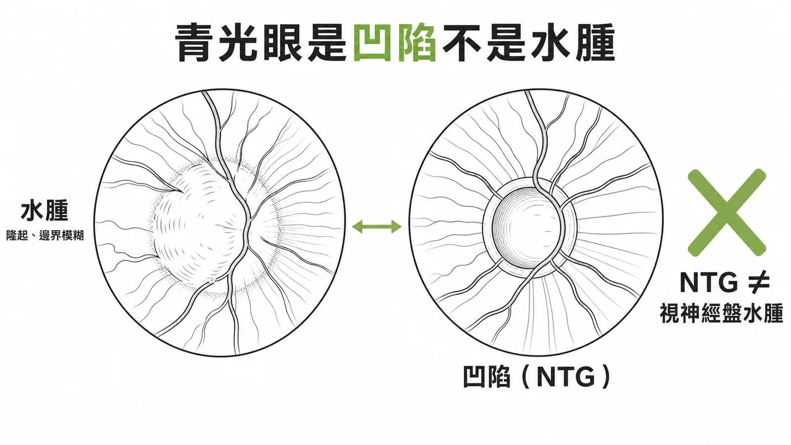 正常眼壓性青光眼是視神經盤凹陷而非水腫示意圖