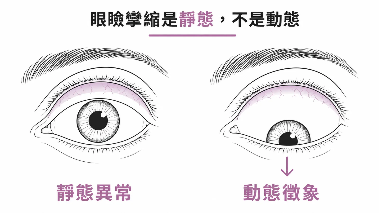 眼瞼攣縮是靜態位置異常與 Von Graefe 動態徵象對比圖