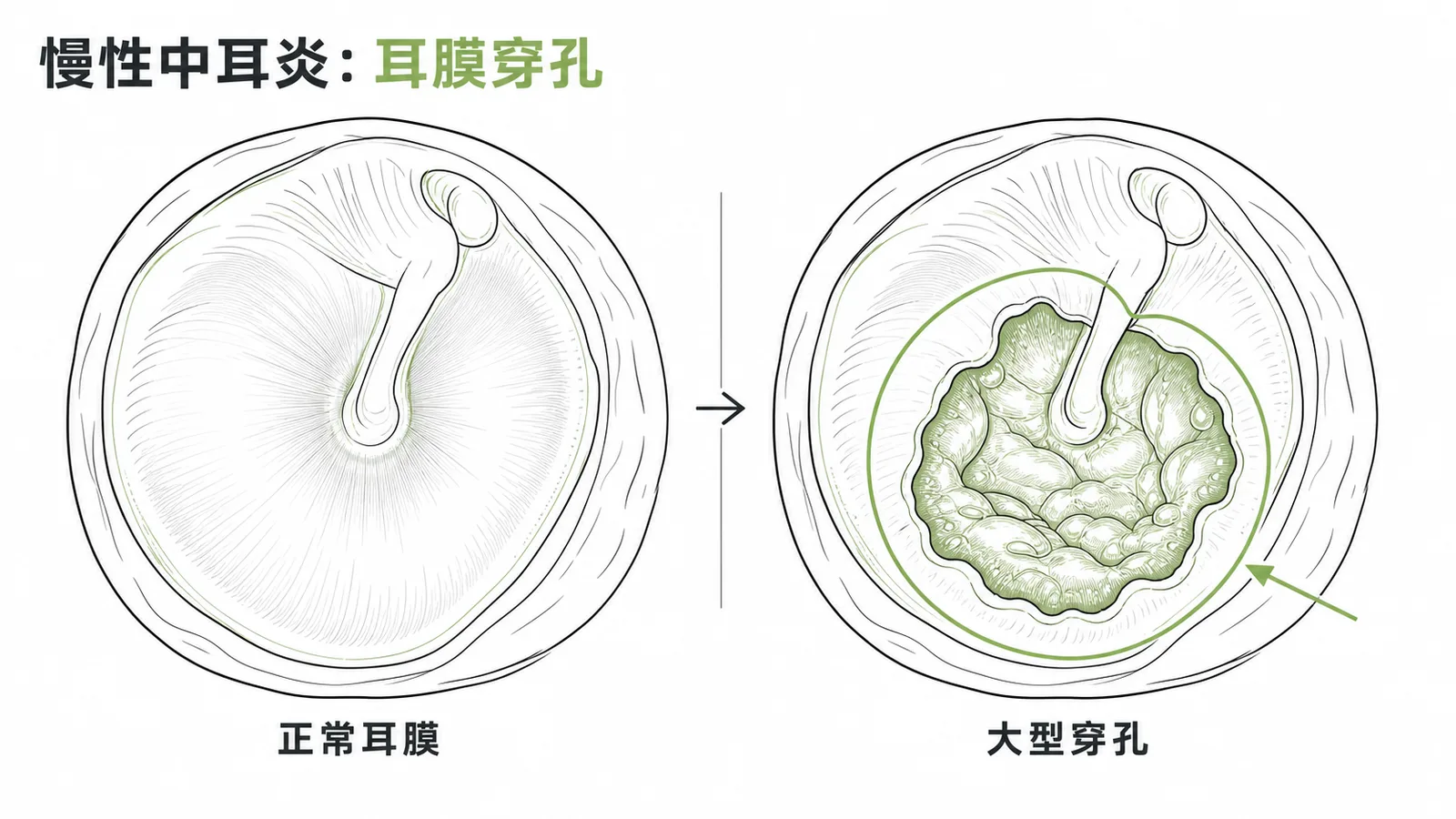 慢性中耳炎:正常耳膜與大型穿孔對照
