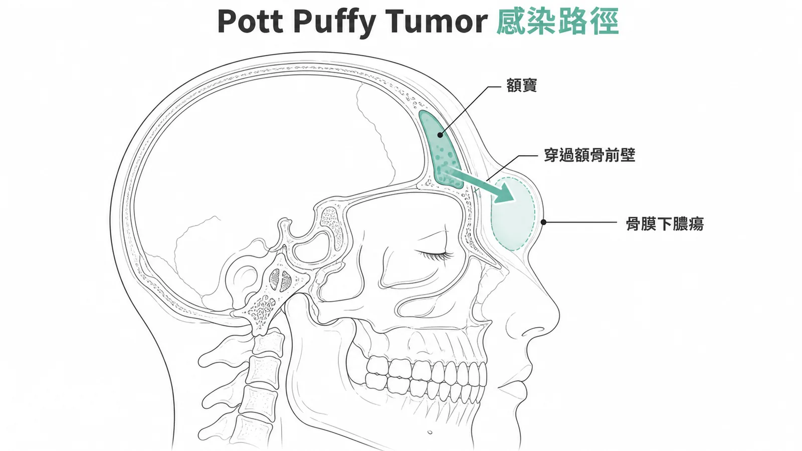 Pott Puffy Tumor 額竇感染穿過額骨形成骨膜下膿瘍的路徑
