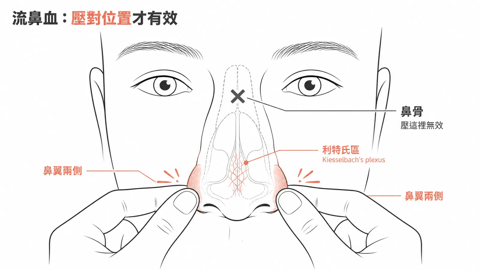 流鼻血正確加壓位置:鼻翼兩側而非鼻骨