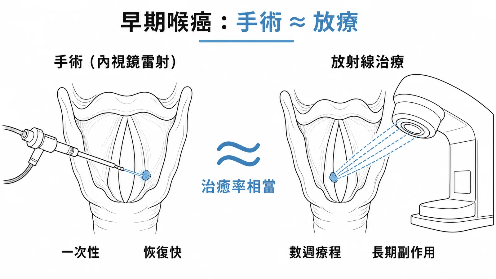 早期喉癌手術與放療治癒率相當的對照示意