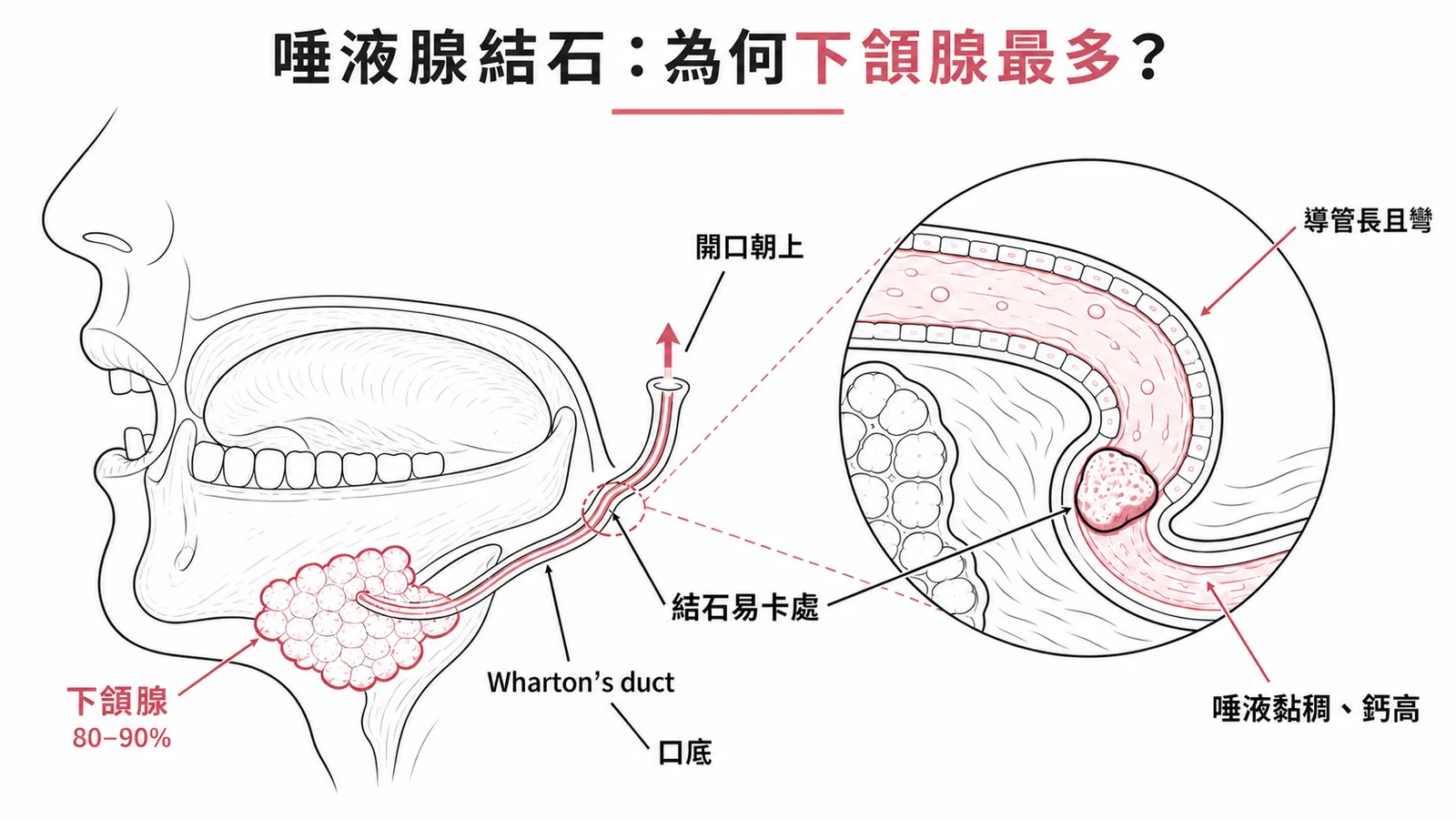 下頷腺導管結構與唾液腺結石好發原因示意