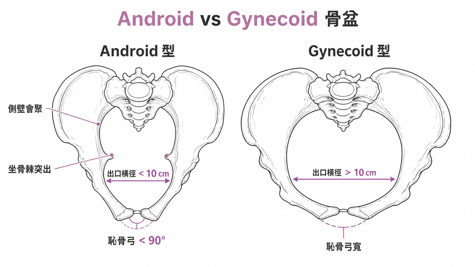 Android與Gynecoid骨盆形態對照