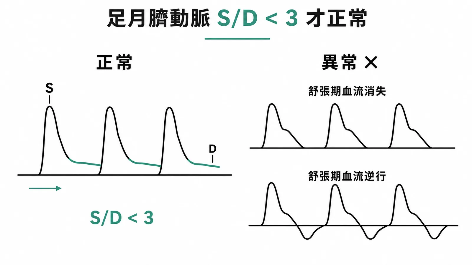 臍動脈 Doppler 波形:正常 S/D < 3 vs 異常(舒張期血流消失或逆行)