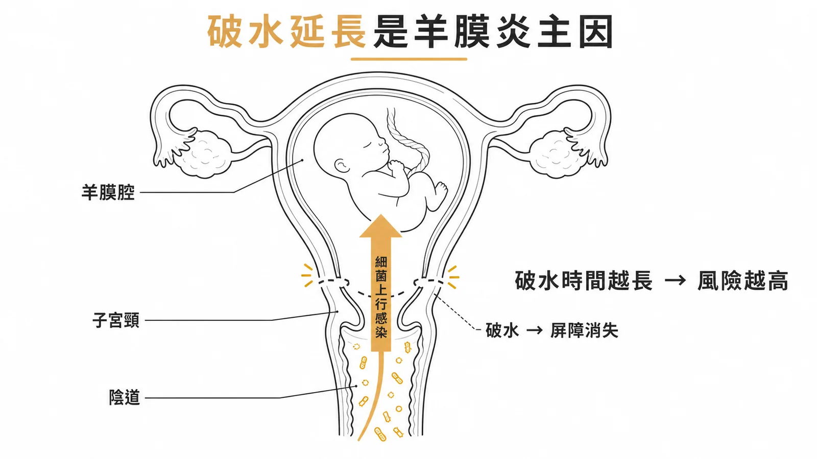絨毛膜羊膜炎上行感染途徑:破水後細菌從陰道經子宮頸進入羊膜腔