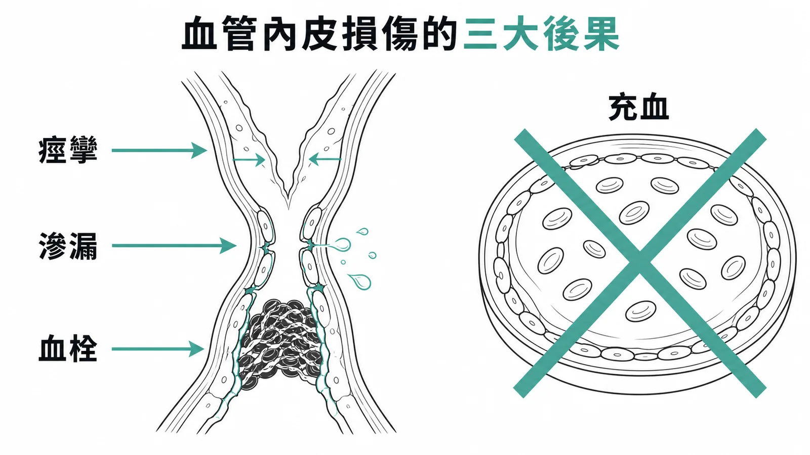 子癇前症血管內皮損傷的三大後果:痙攣、滲漏、血栓,但不包含充血