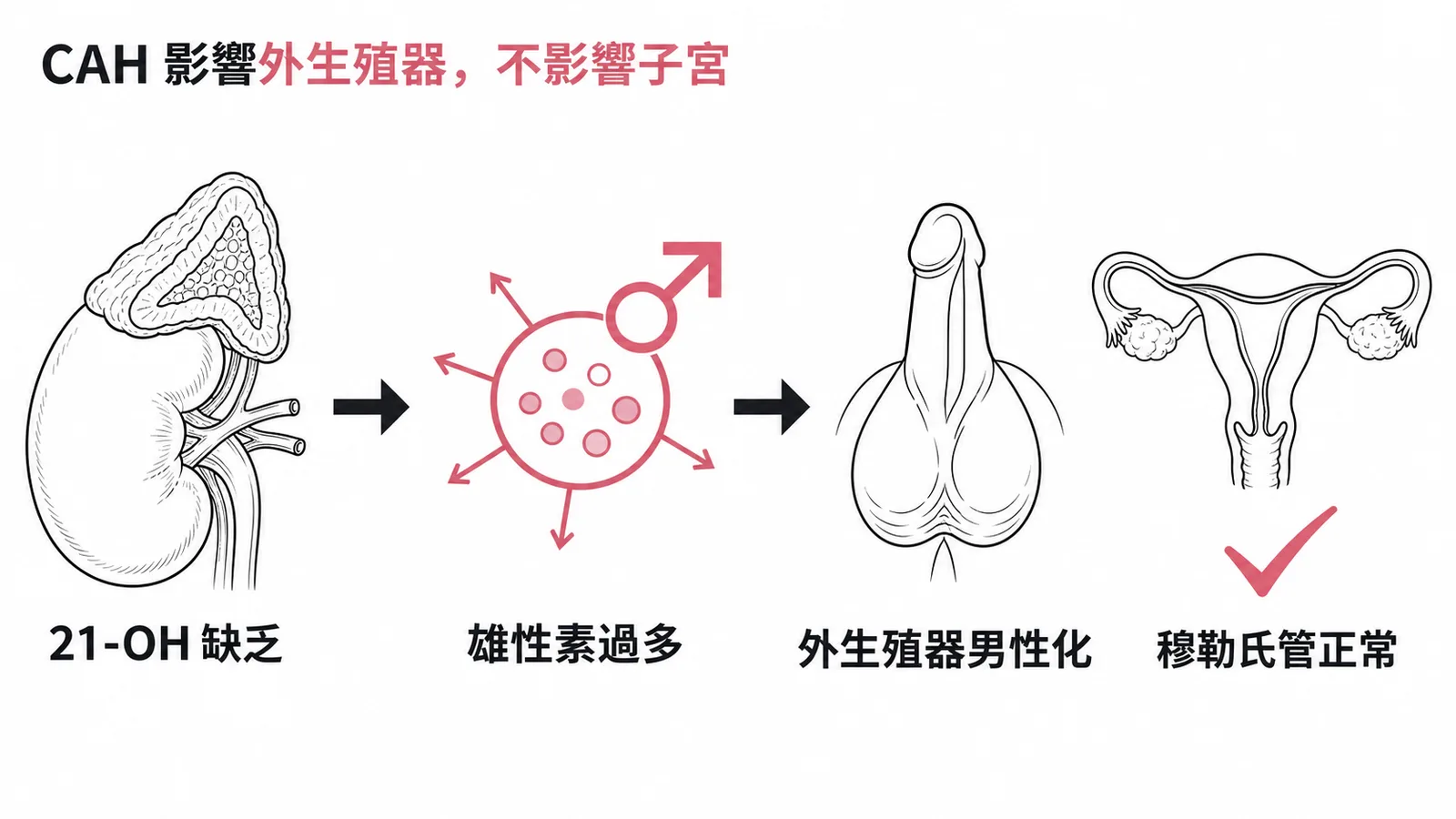 CAH影響外生殖器但不影響穆勒氏管與子宮發育