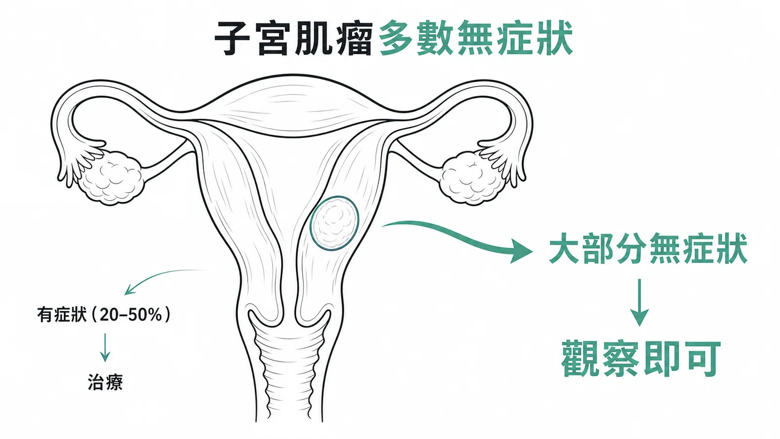 子宮肌瘤多數無症狀,僅20-50%需要治療