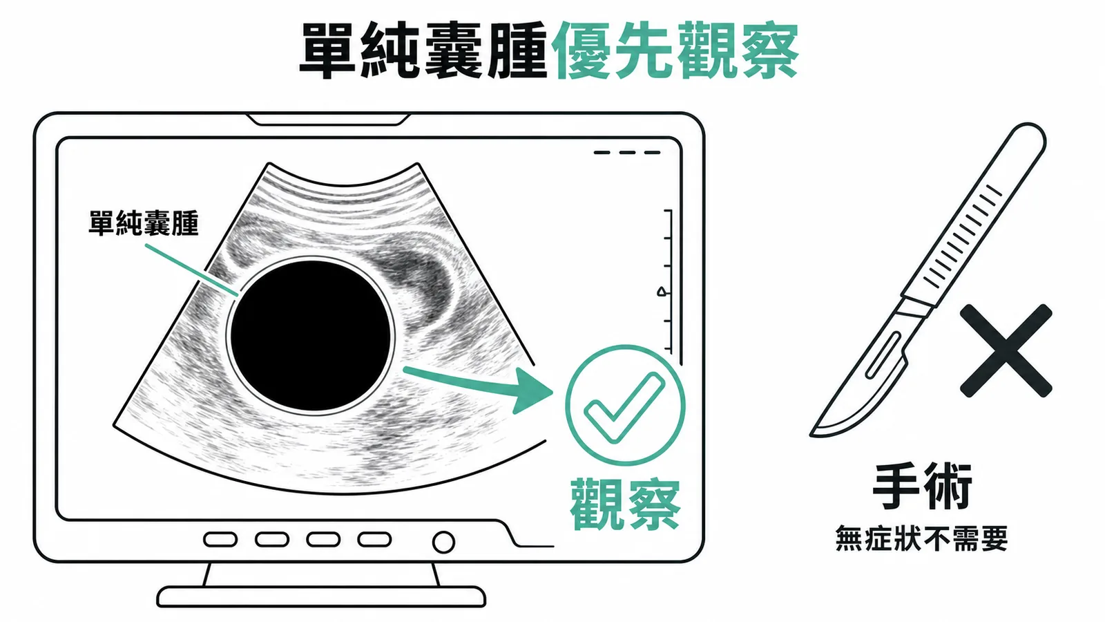 青春期前單純卵巢囊腫優先密切觀察,無症狀不需手術