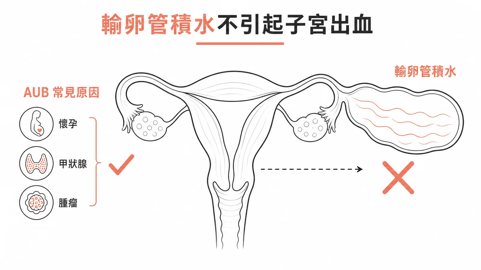 輸卵管積水不引起子宮出血,AUB常見原因為懷孕、甲狀腺異常、腫瘤