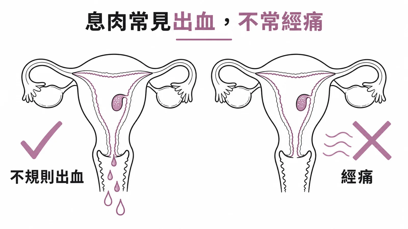 子宮內膜息肉常見不規則出血但通常不造成經痛