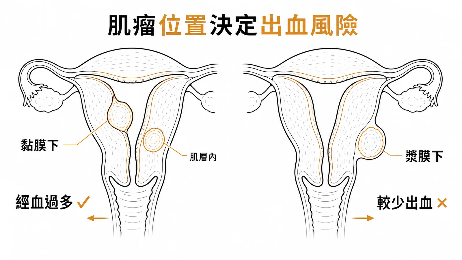 子宮肌瘤位置決定出血風險:黏膜下最易經血過多,漿膜下較少出血