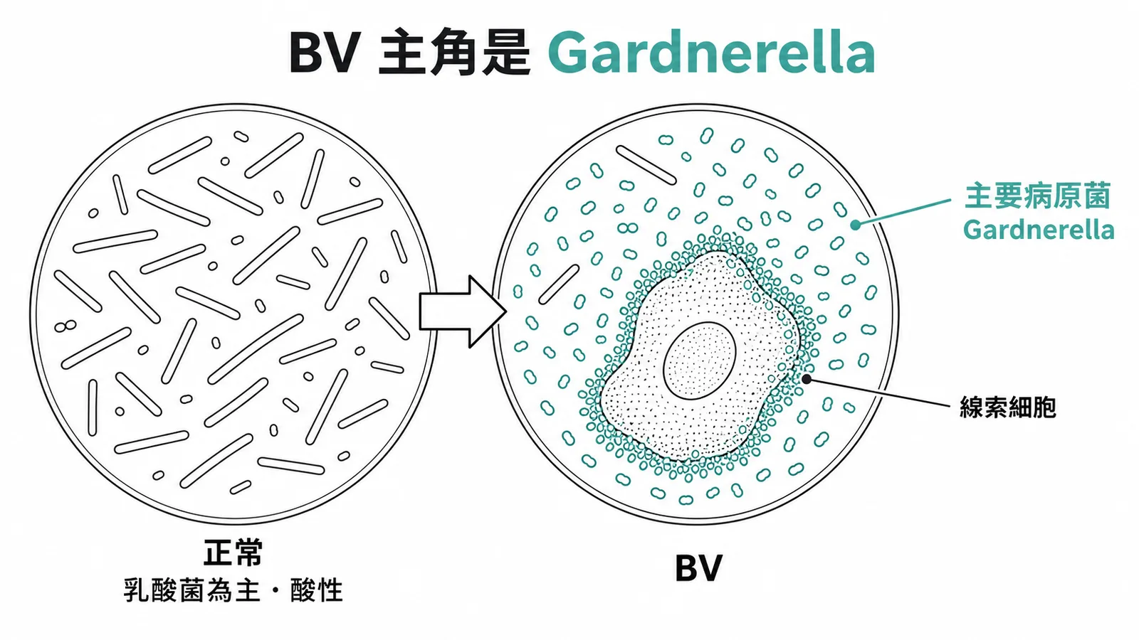 細菌性陰道炎主要病原菌為Gardnerella,正常乳酸菌減少後厭氧菌過度生長