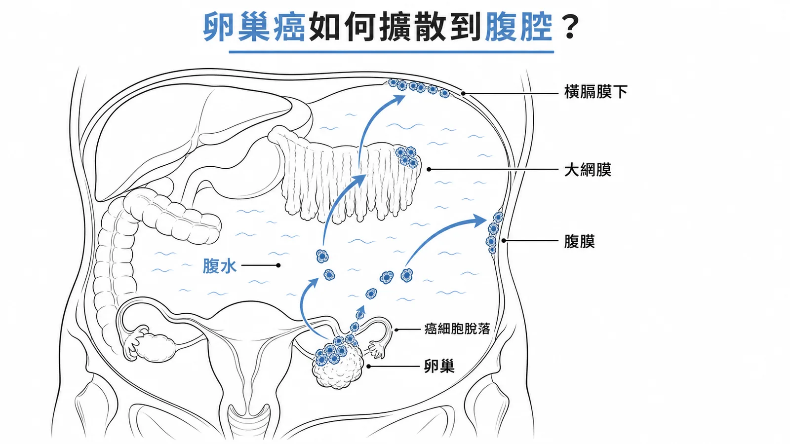 卵巢癌腹膜擴散路徑示意圖:癌細胞從卵巢脫落,隨腹水附著到大網膜、腹膜與橫膈膜下