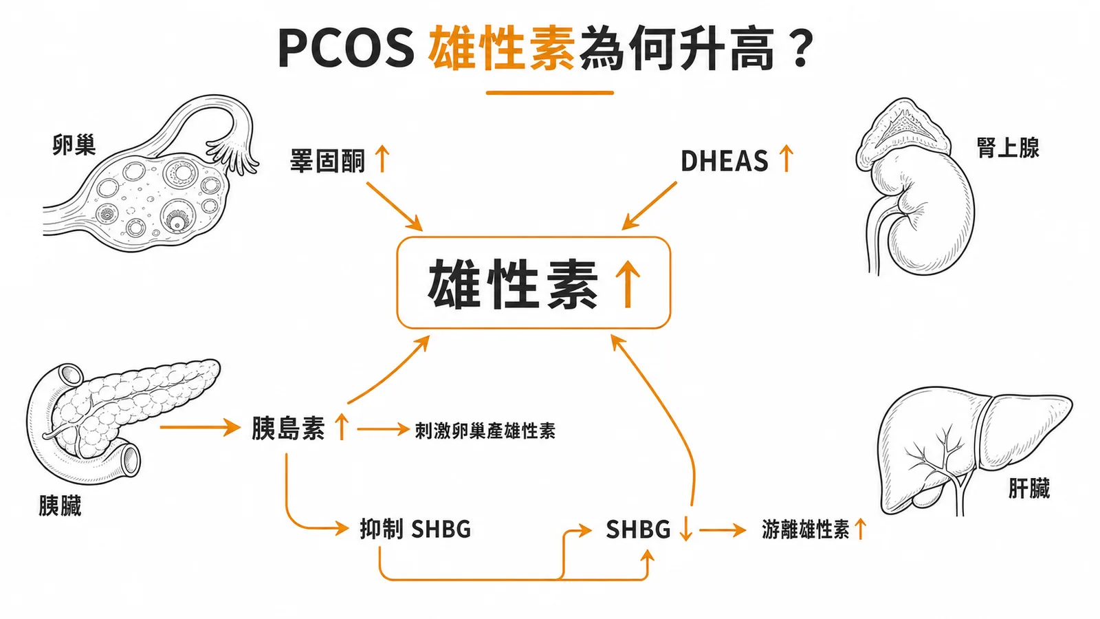 PCOS雄性素升高機轉:卵巢睪固酮、腎上腺DHEAS、胰島素刺激與SHBG下降四路匯入