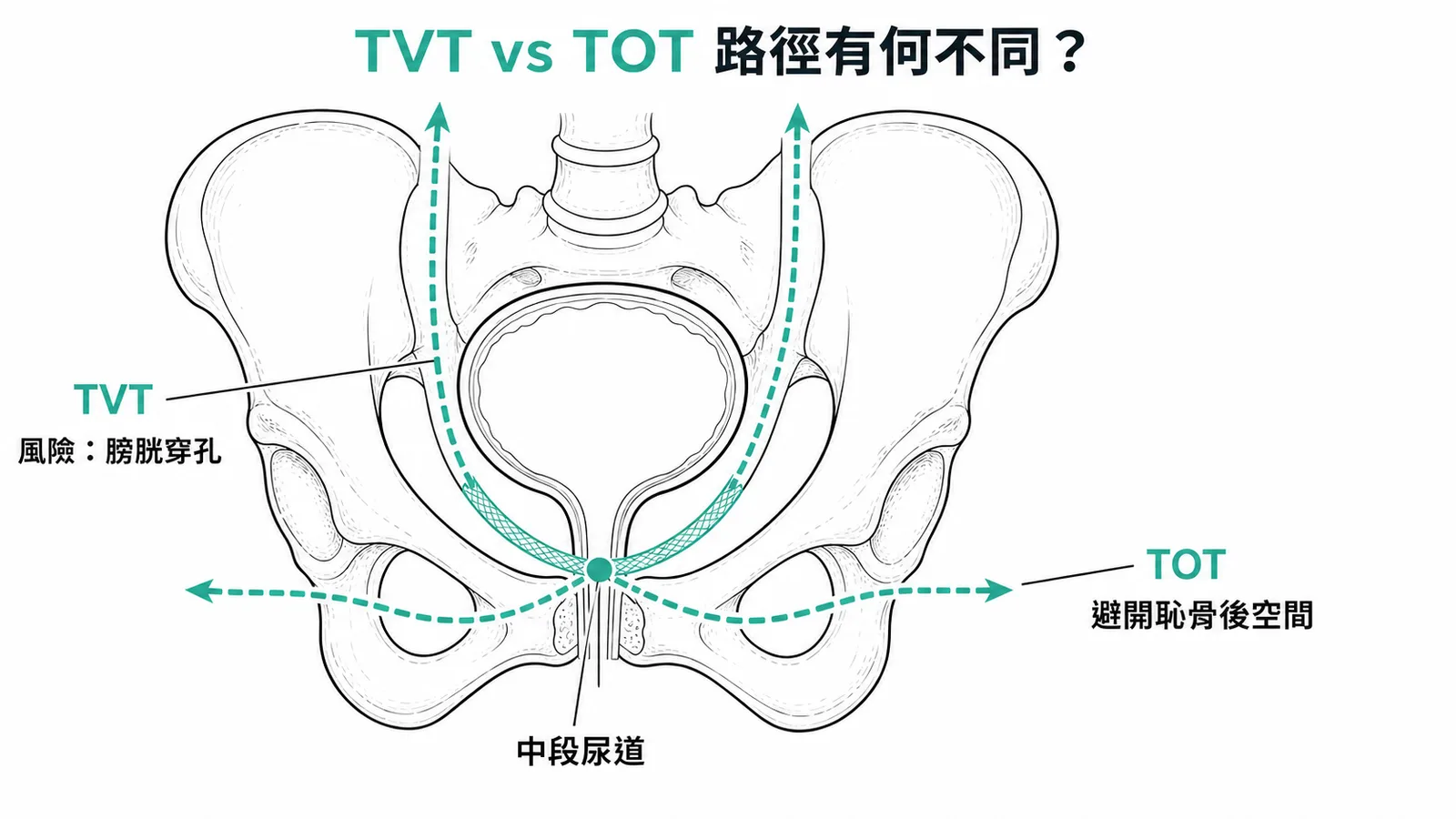 TVT與TOT穿刺路徑對比:TVT經恥骨後空間有膀胱穿孔風險,TOT經閉孔避開恥骨後空間