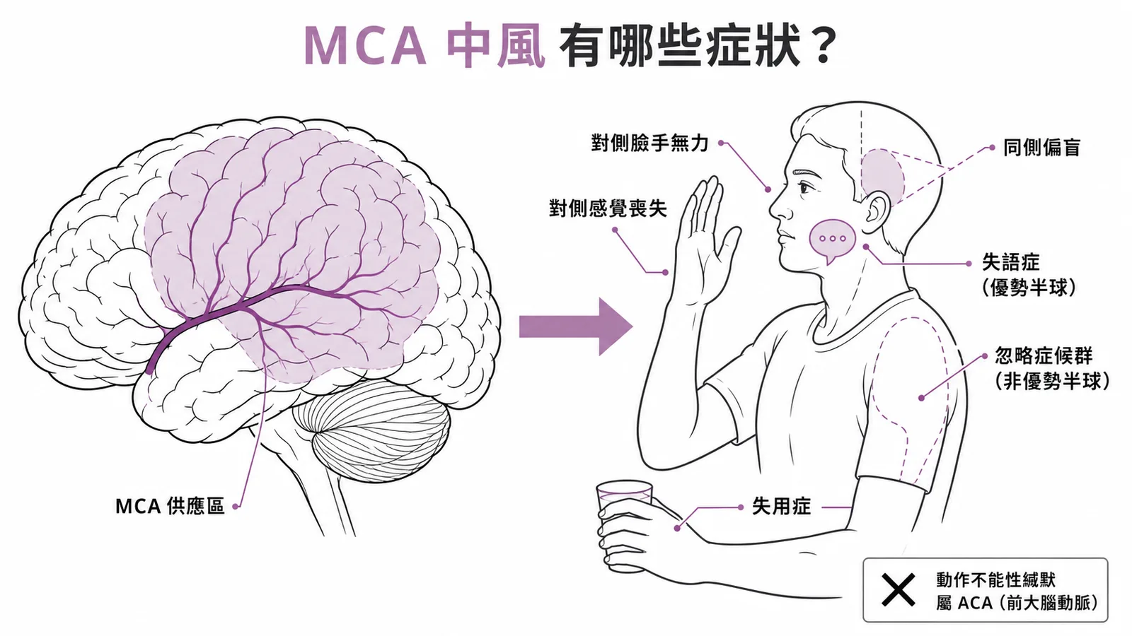 MCA中風典型症狀:對側臉手無力、感覺喪失、偏盲、失語、忽略症候群、失用症;動作不能性緘默屬ACA