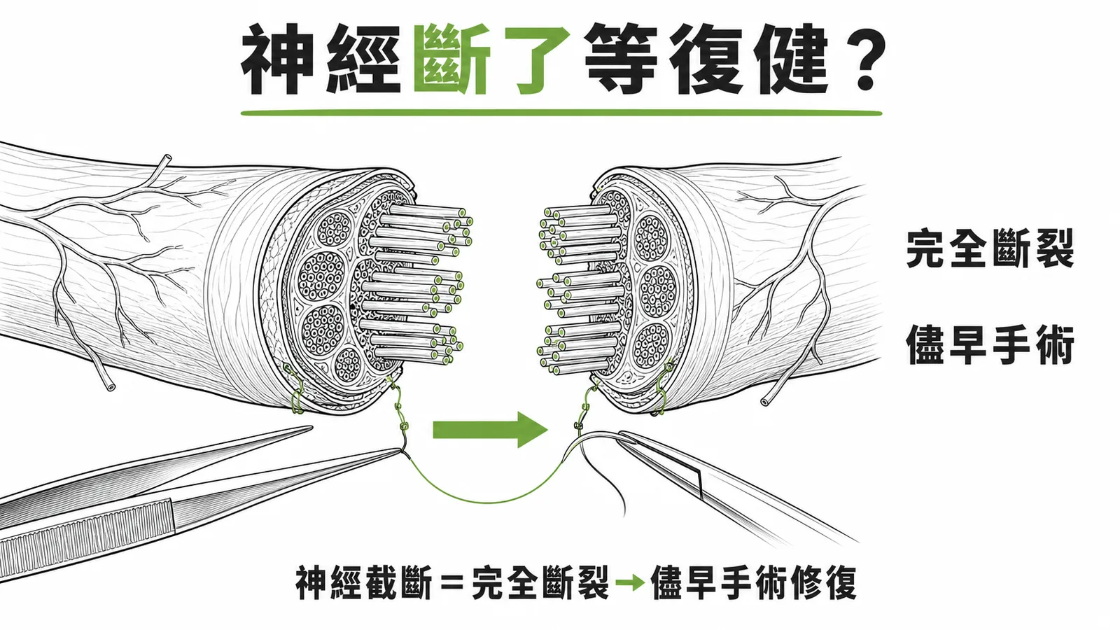 周邊神經損傷三級分類:神經截斷為完全斷裂,必須儘早手術修復