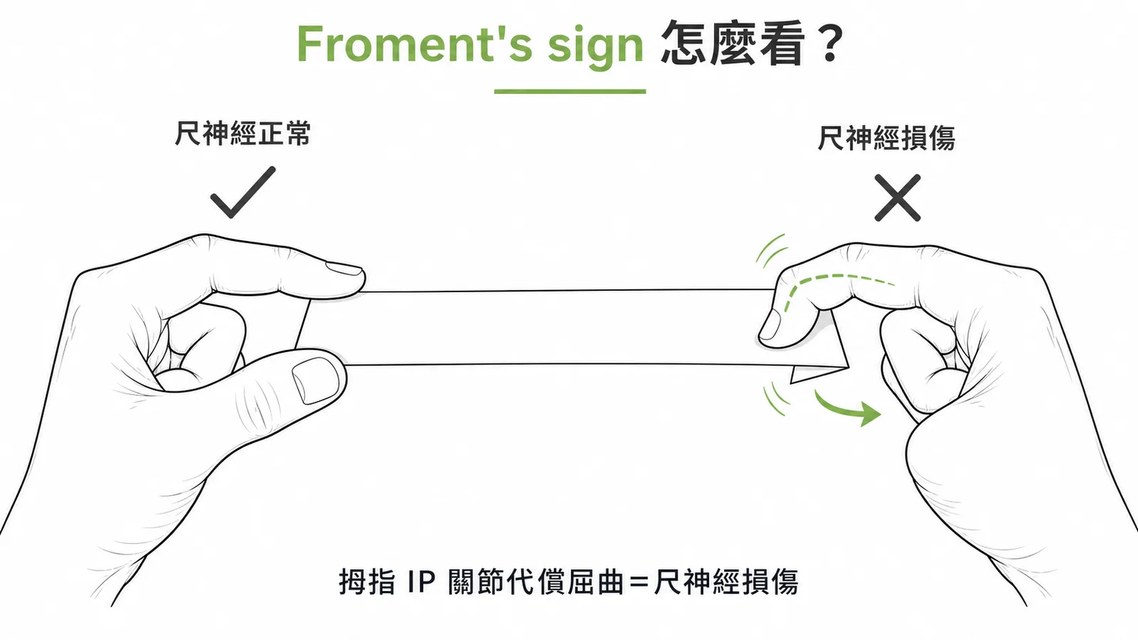 Froment's sign:尺神經損傷時拇指IP關節代償屈曲