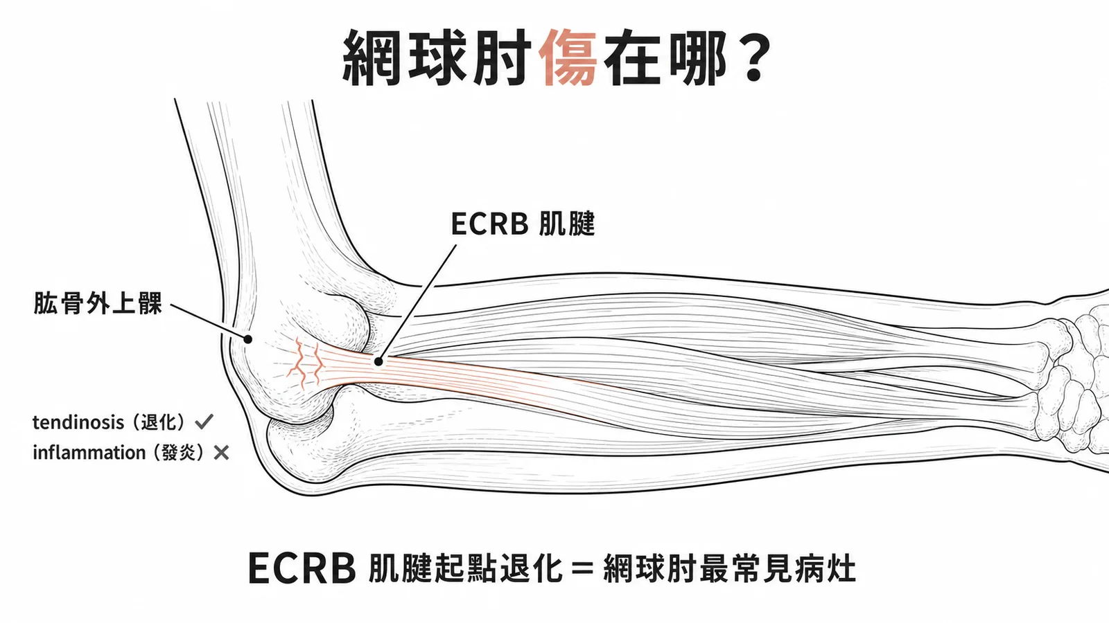 網球肘病灶:ECRB肌腱起點退化而非發炎