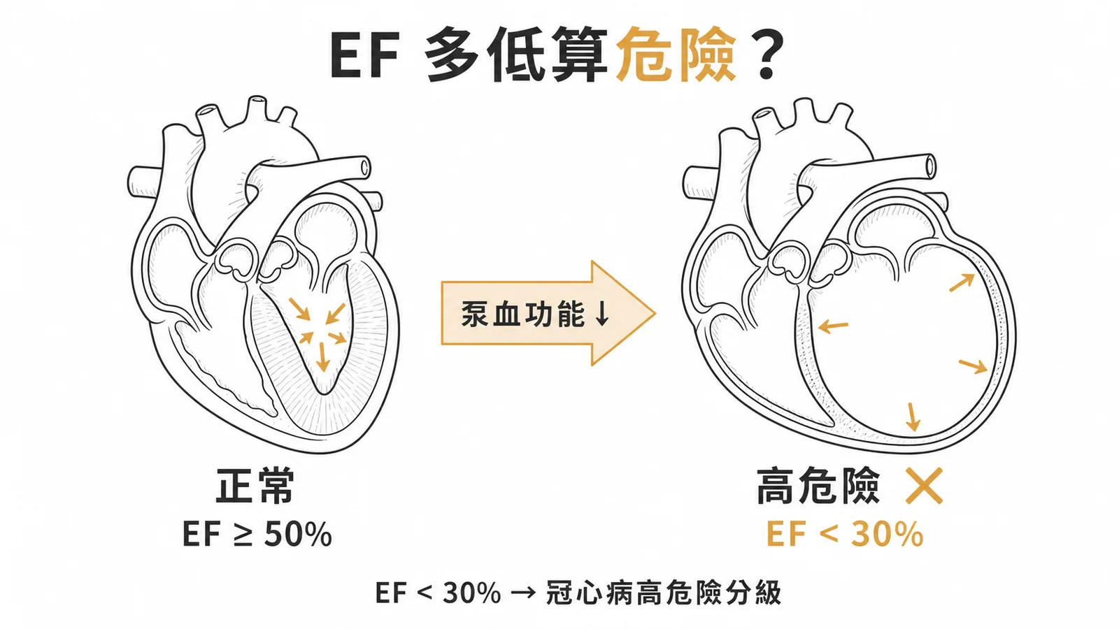 左心室排血分數EF低於30%屬冠心病高危險分級
