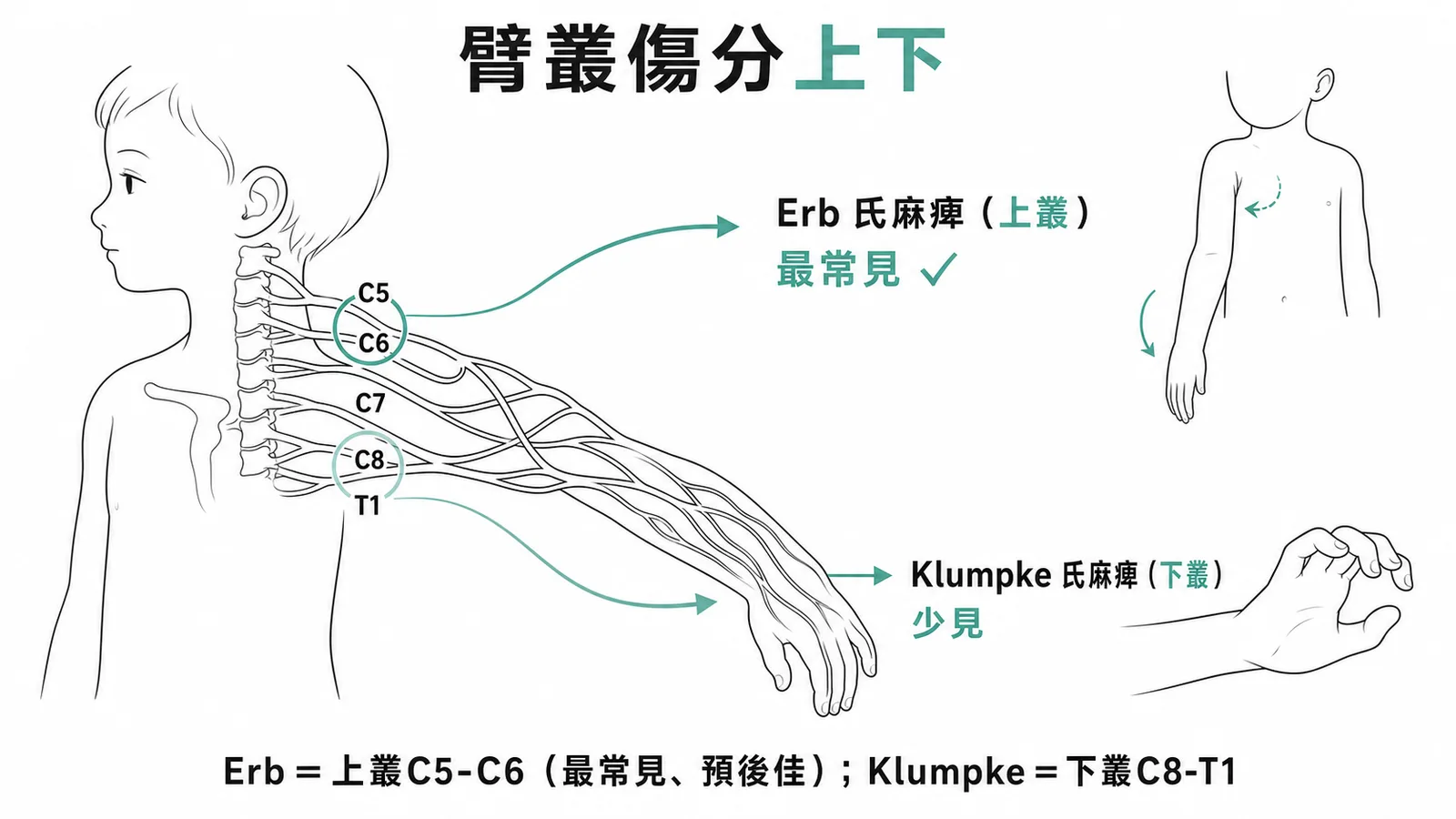 臂神經叢損傷分上下：Erb上叢C5-C6最常見，Klumpke下叢C8-T1少見
