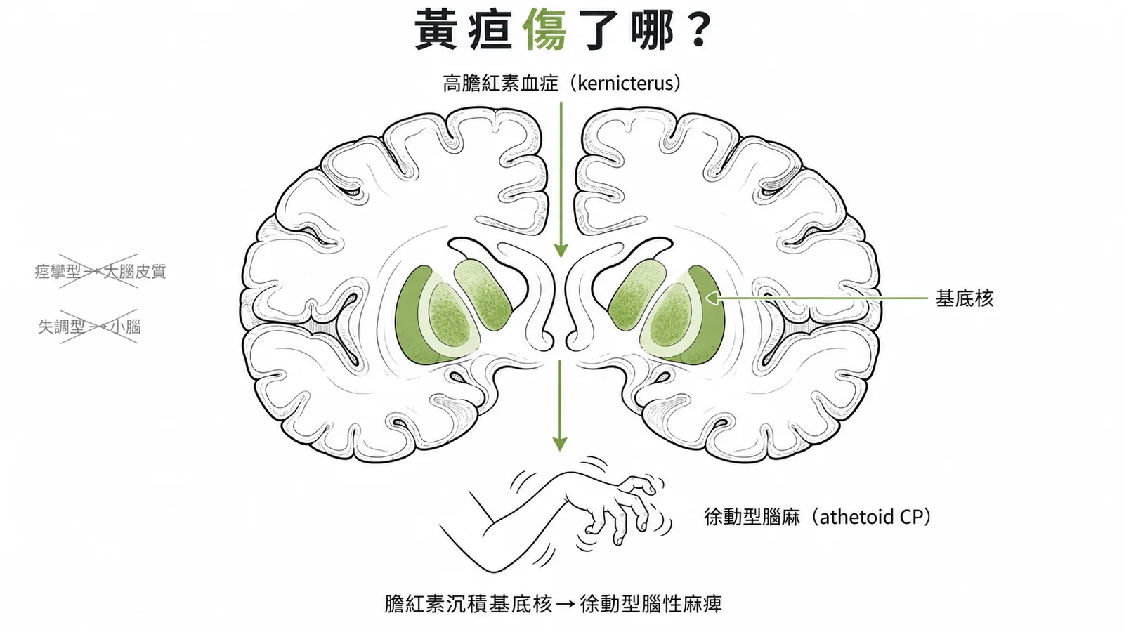 膽紅素沉積基底核導致徐動型腦性麻痺