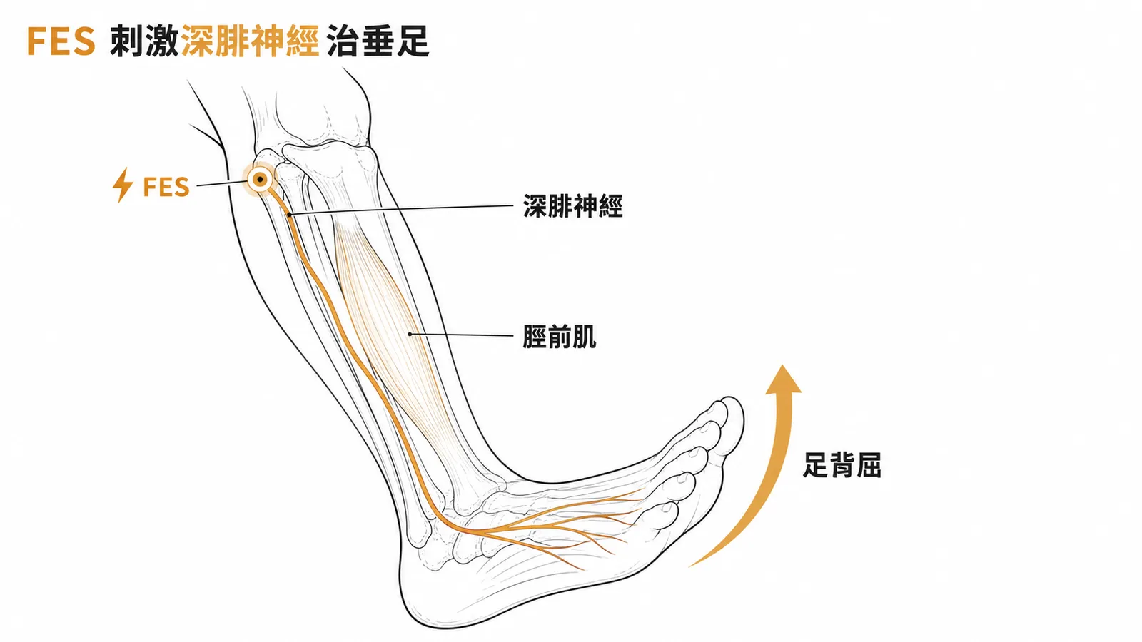 FES 透過電刺激深腓神經使足部背屈肌收縮,改善垂足步態