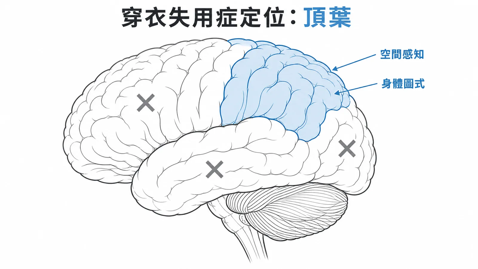 穿衣失用症與頂葉定位:頂葉負責空間感知與身體圖式