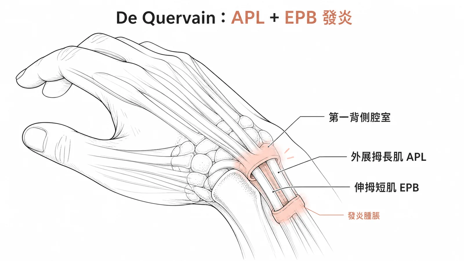 De Quervain 肌腱腱鞘炎:外展拇長肌與伸拇短肌在第一背側腔室發炎