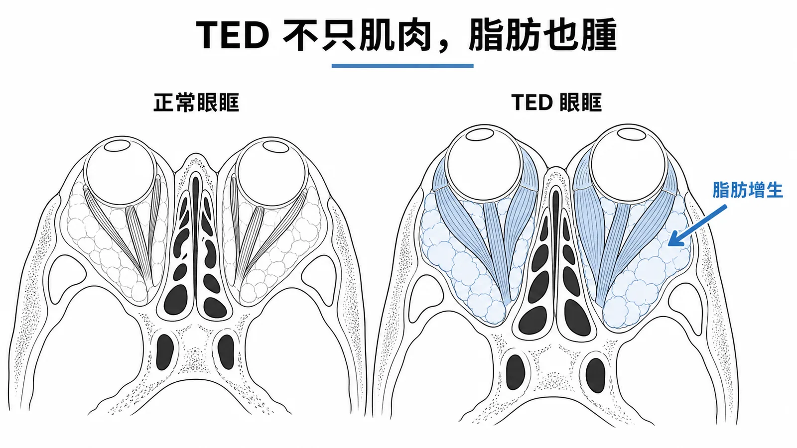 甲狀腺眼病眼眶變化：眼外肌腫大加上脂肪增生水腫