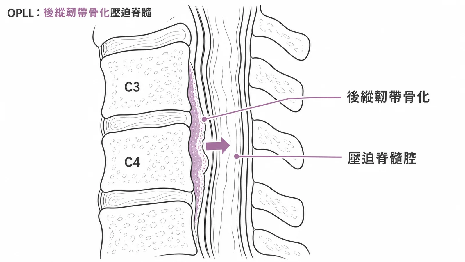 OPLL:頸椎後縱韌帶骨化向後壓迫脊髓腔