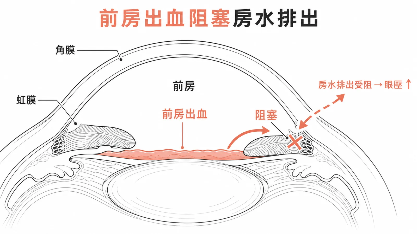 前房出血沉積阻塞小樑網，導致房水排出受阻、眼壓升高