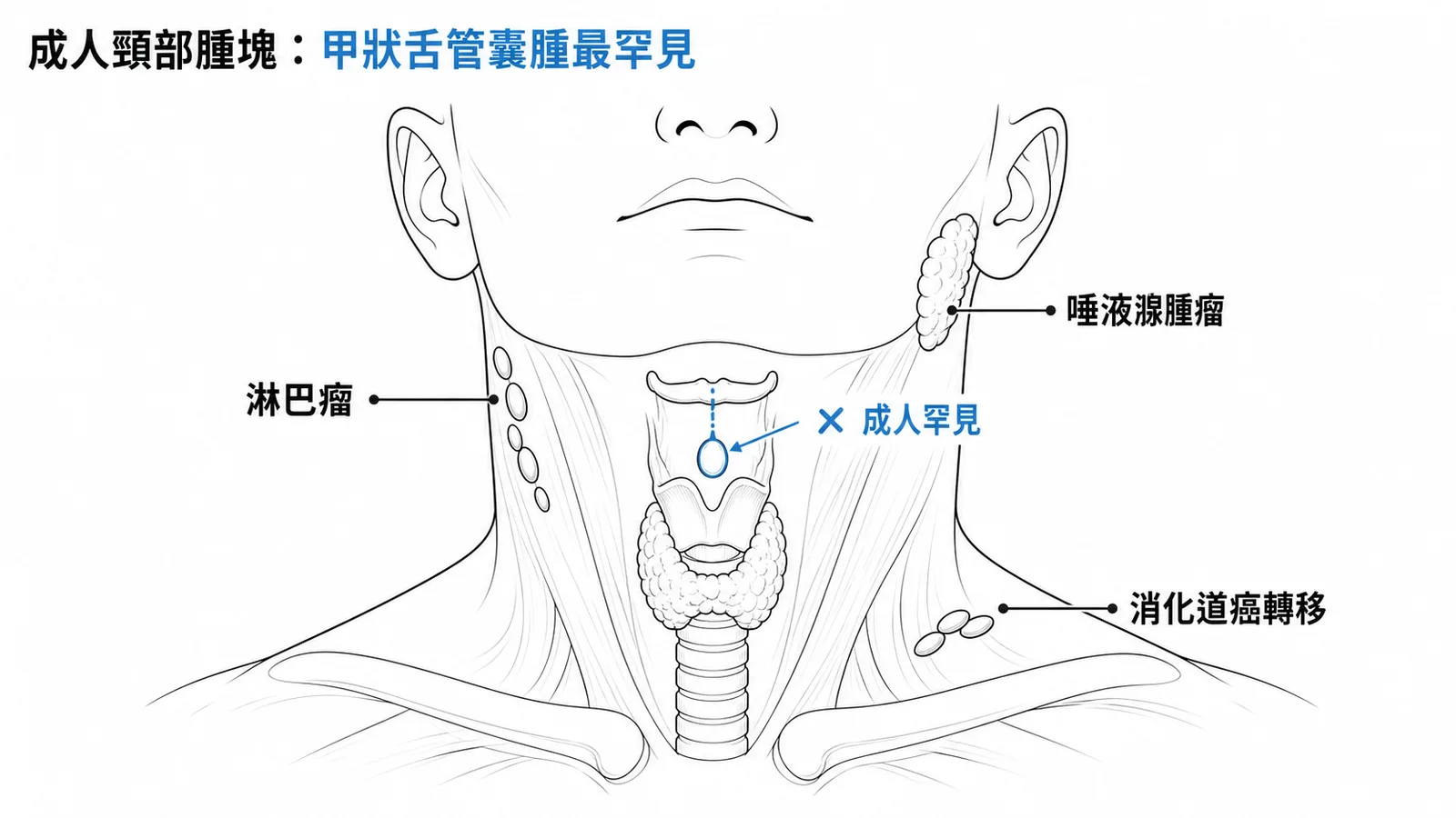 成人頸部腫塊鑑別:甲狀舌管囊腫為先天性,成人最罕見