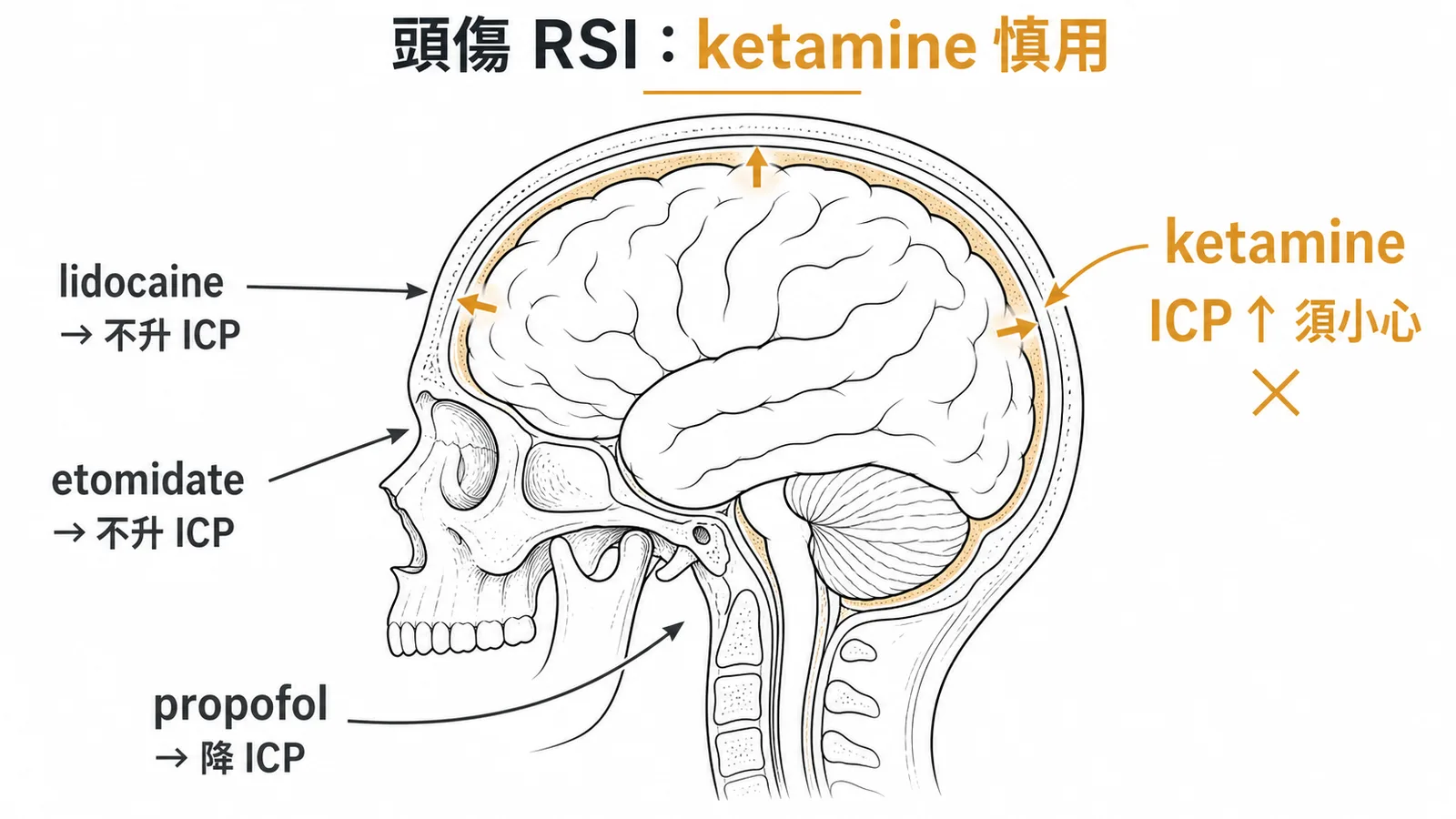 頭傷RSI用藥比較：ketamine可能升高顱內壓，須特別小心