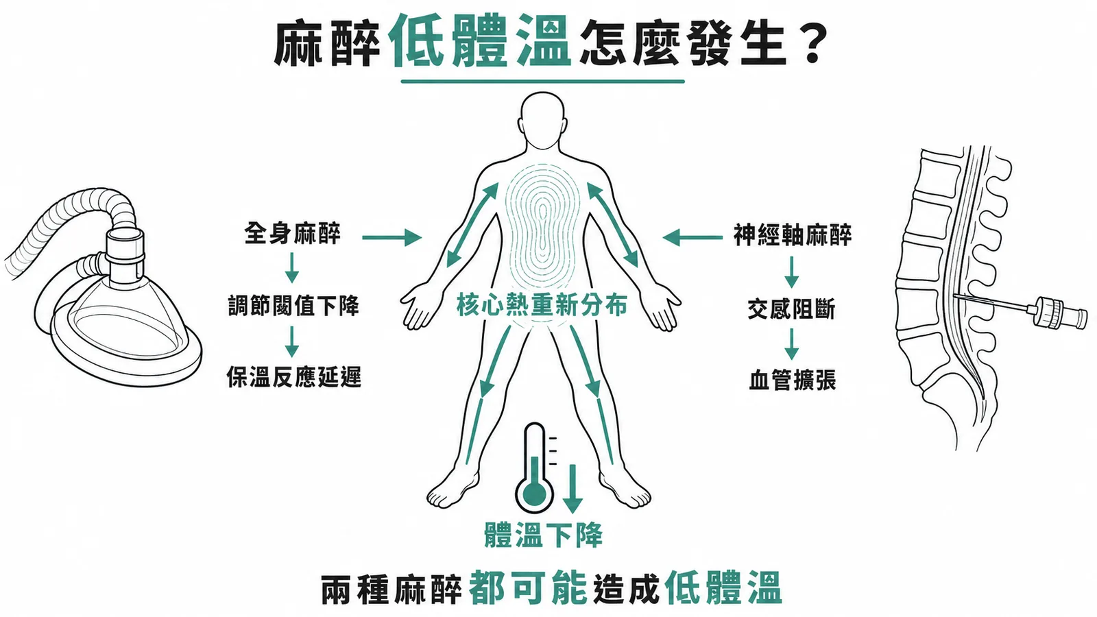 麻醉低體溫機轉:全身與神經軸麻醉都會透過核心體熱重新分布造成低體溫