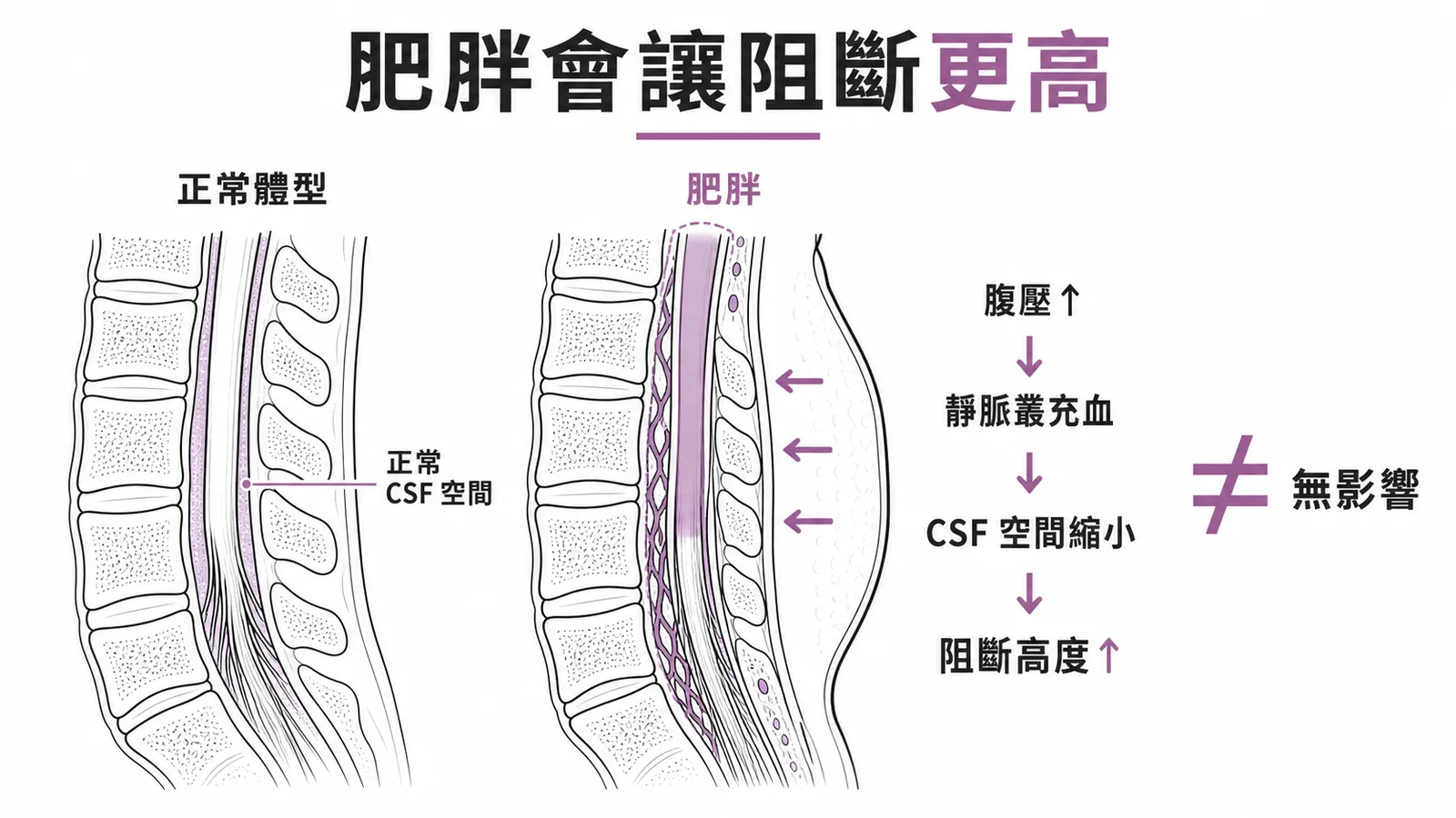 肥胖會讓脊椎麻醉阻斷高度更高:腹壓增加使 CSF 空間縮小