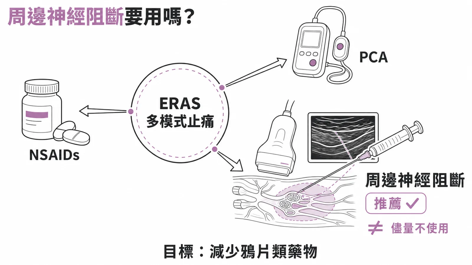 ERAS 多模式止痛：周邊神經阻斷是推薦項目，非儘量不用