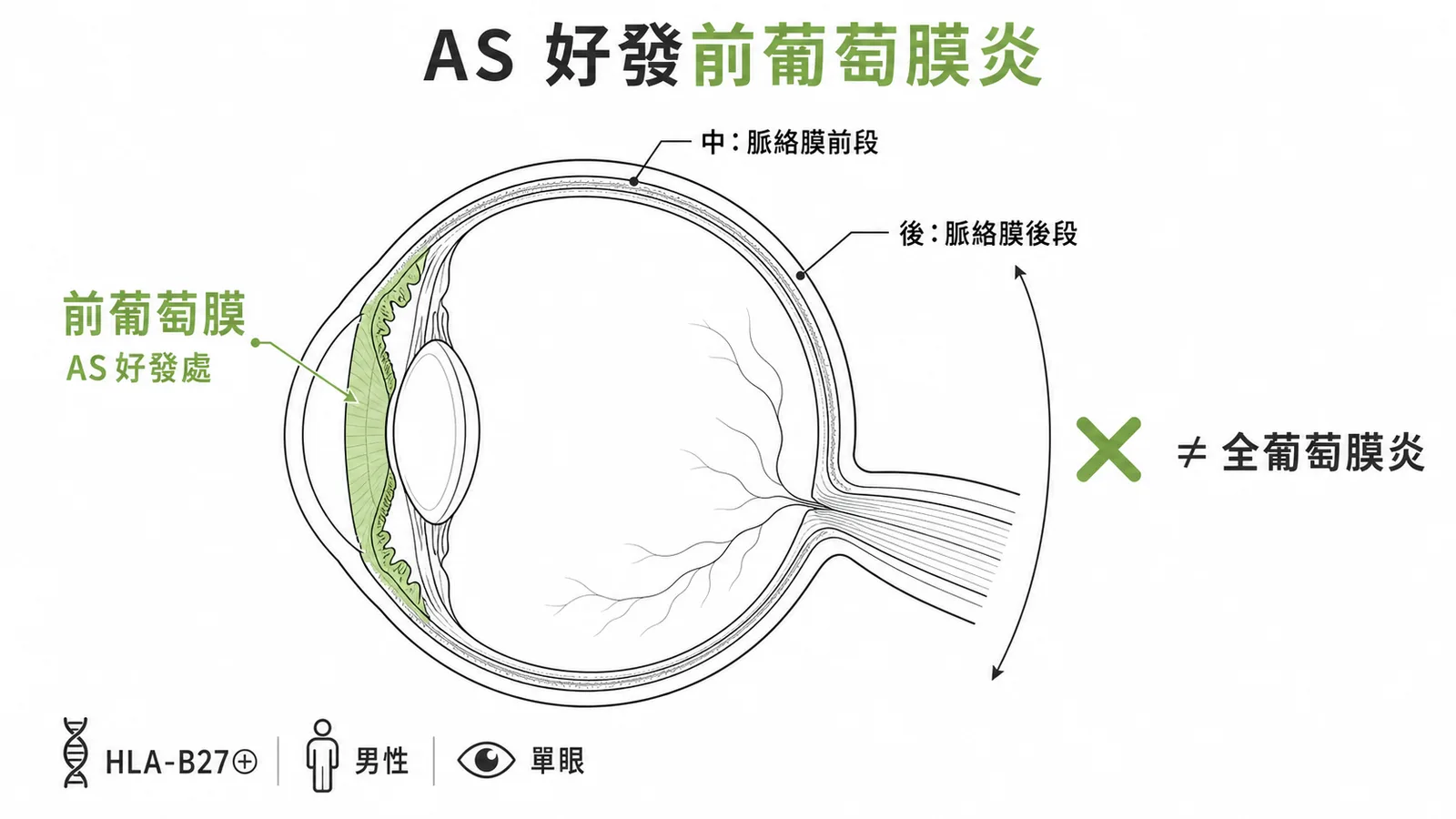 僵直性脊椎炎好發急性前葡萄膜炎，非全葡萄膜炎