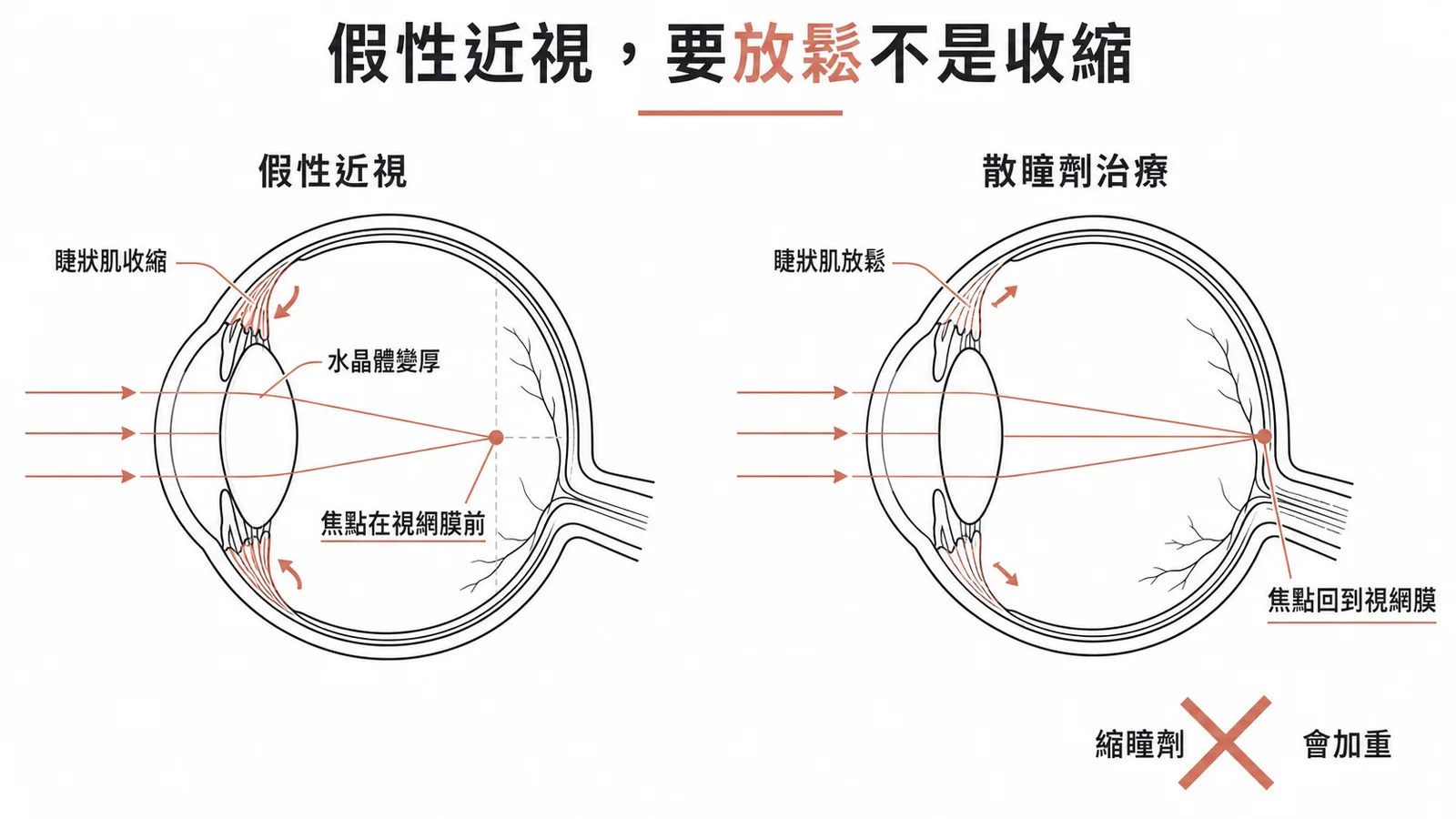 假性近視治療要放鬆睫狀肌（散瞳劑），縮瞳劑反而加重