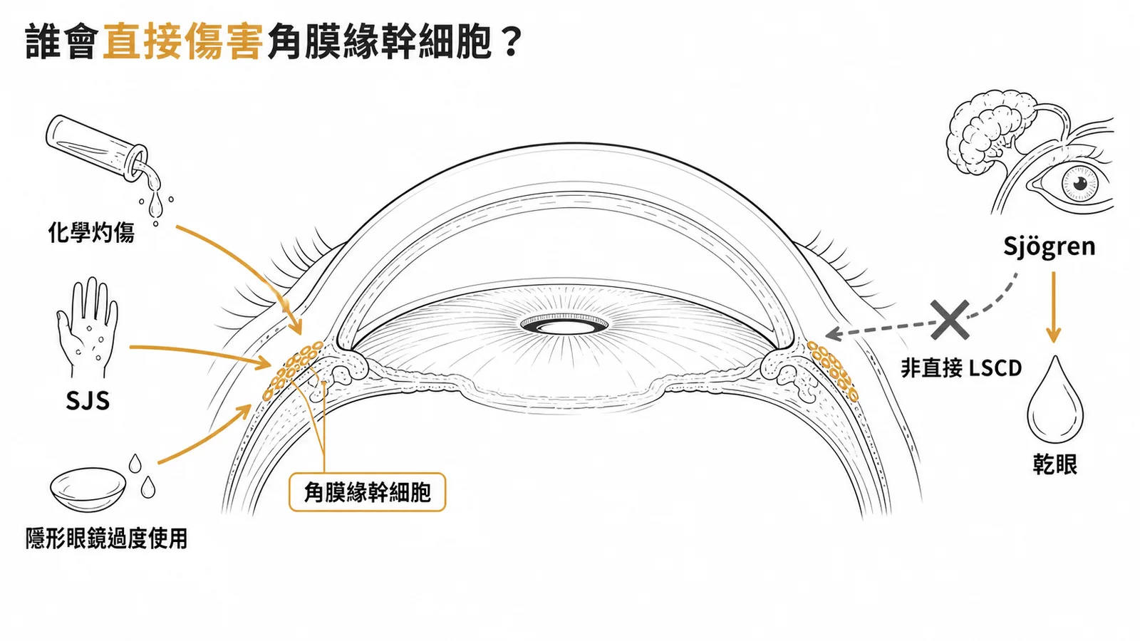 角膜緣幹細胞缺乏症病因：化學灼傷、SJS、隱形眼鏡會直接破壞；Sjögren 主要造成乾眼