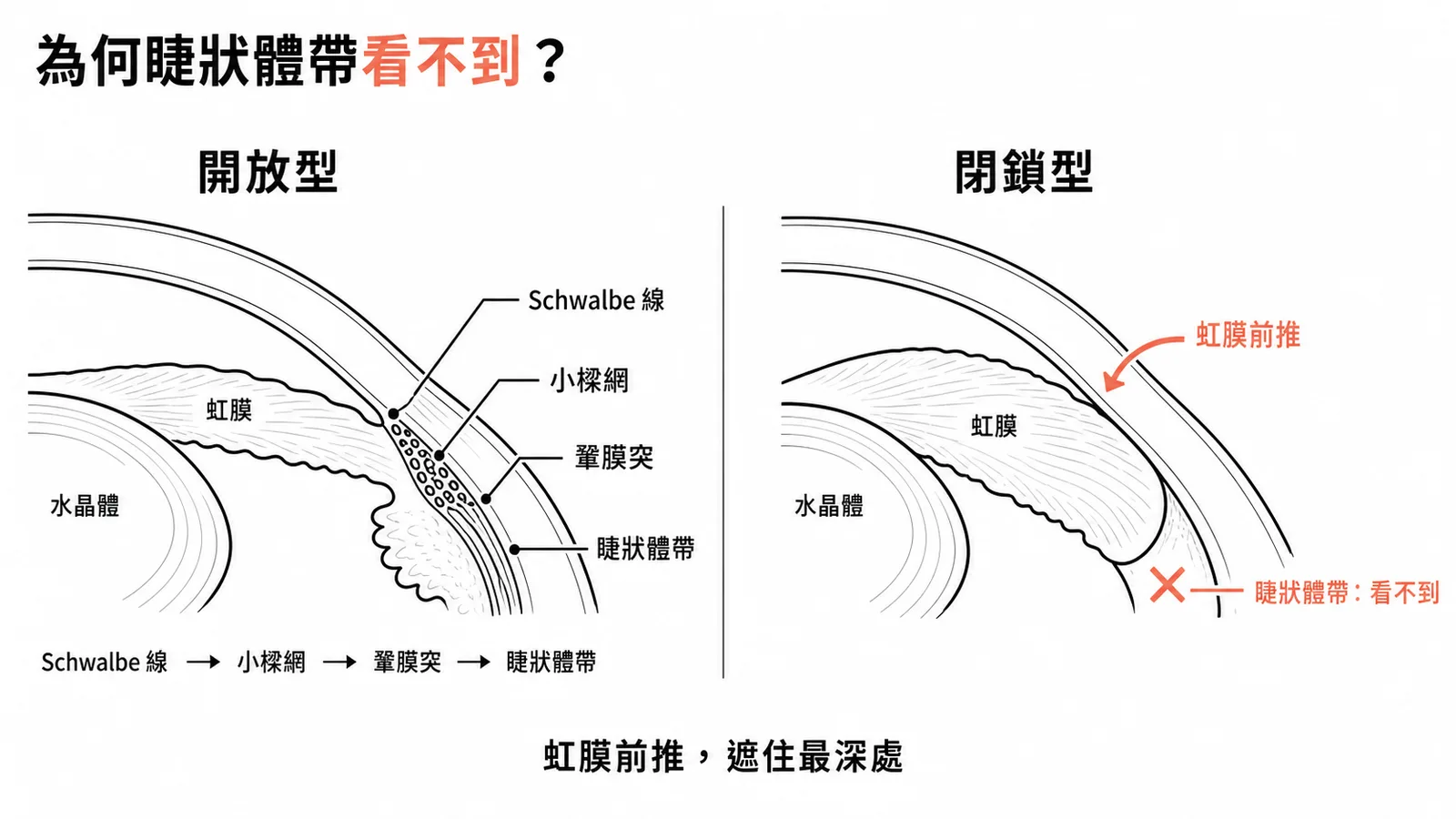 隅角閉鎖性青光眼：虹膜前推遮住最深處的睫狀體帶，一定看不到