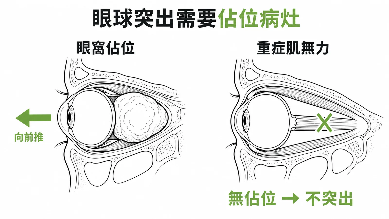眼球突出需要眼窩佔位病灶，重症肌無力僅肌肉無力不會突出