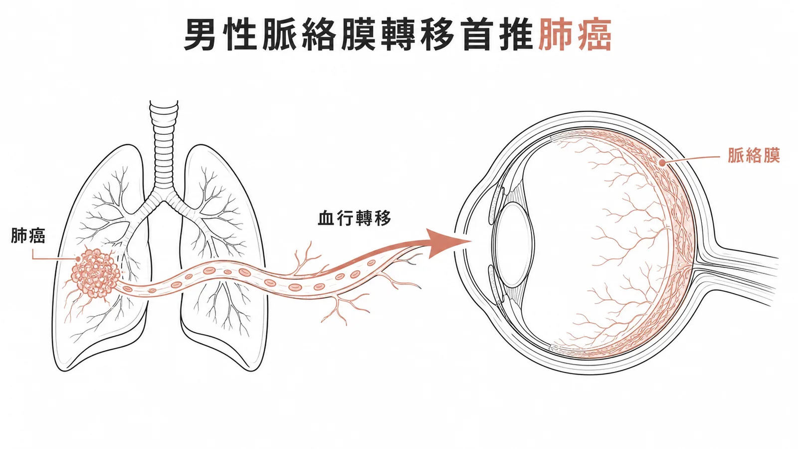 男性脈絡膜轉移最常見來源為肺癌，經血行轉移至血管豐富的脈絡膜