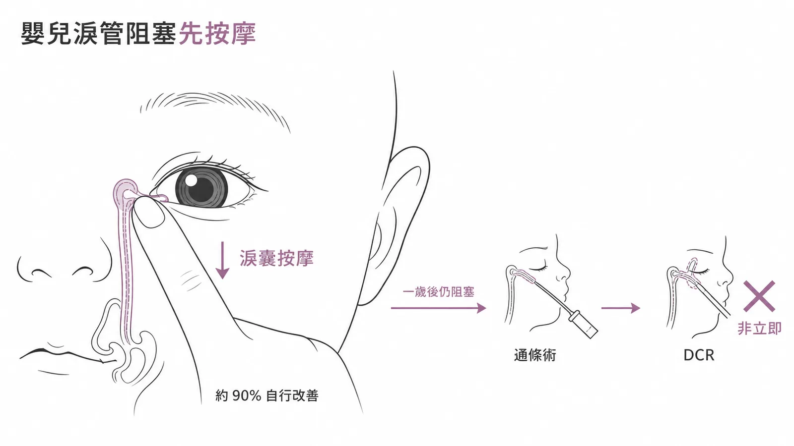 嬰兒鼻淚管阻塞處置流程：先按摩淚囊，非立即手術